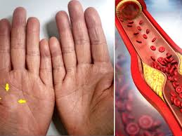 síntomas del colesterol